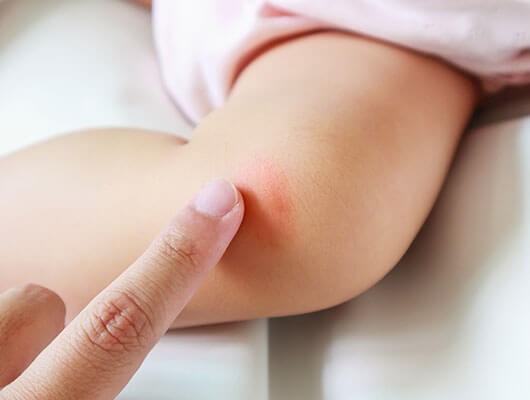 Eczema and Skin Treatments